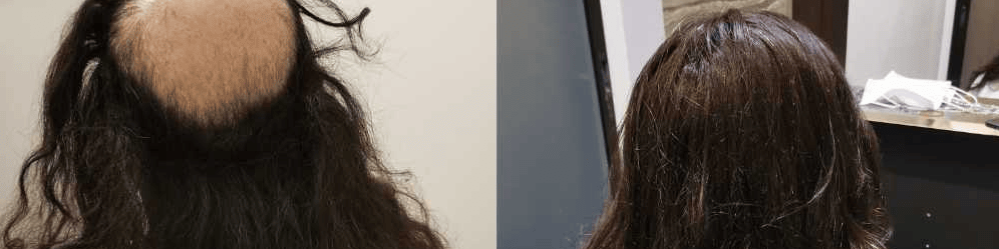 Hair Replacement Singapore