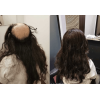 Hair Replacement Singapore